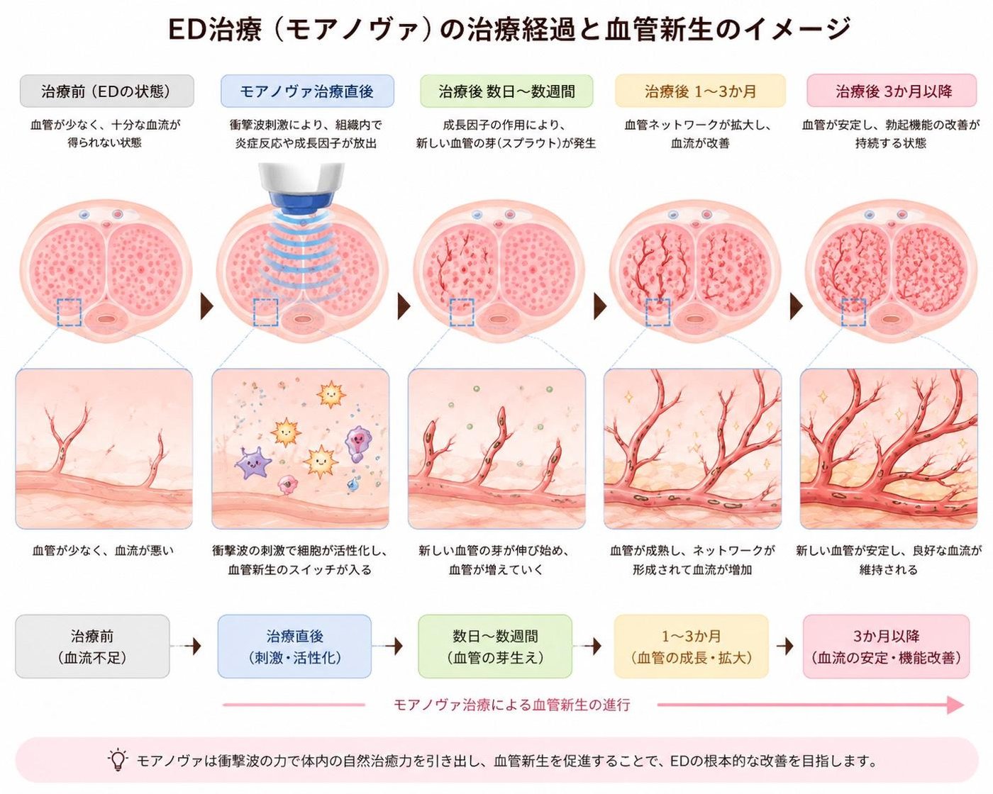 ED治療（モアノヴァ）の治療経過と血管新生のイメージ